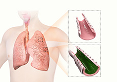 Bronchiectasis