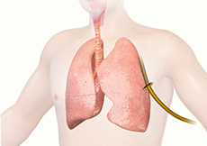 Chest Tube Placement