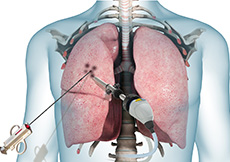 Lung Biopsy