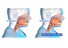 Obstructive Sleep Apnea