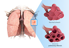 Pulmonary Fibrosis