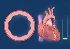 Pulmonary Hypertension