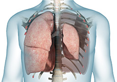 Restrictive Lung Disease