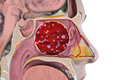 Rhinitis