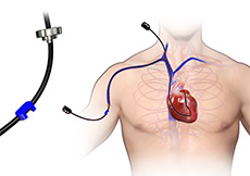 Right Heart Catheterization