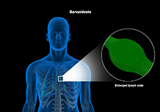 Sarcoidosis