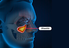 Sinusitis