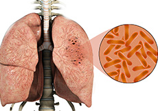 Tuberculosis