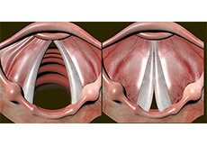 Vocal Cord Dysfunction